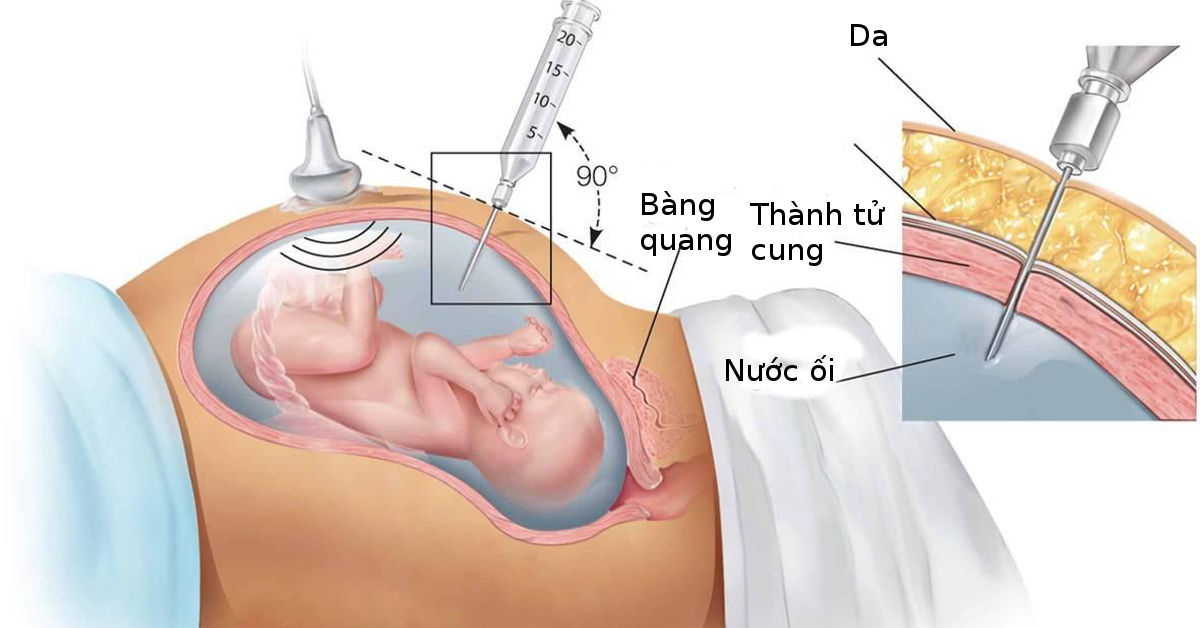 Sàng lọc dị tật trước sinh tại Đô Lương