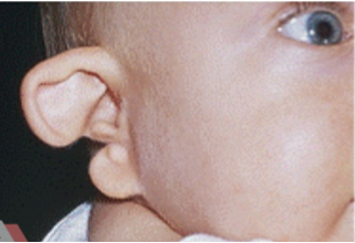 Hình ảnh dị tật vành tai